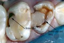 Restorative Dentistry – Poor Choices to be Avoided